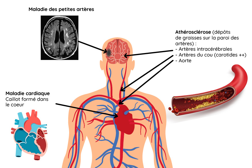 schéma des maladies liées à l'AVC